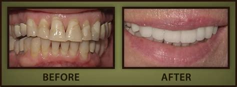 teeth whitening lodi|Dentist in Lodi, CA – The Lodi Dentist.